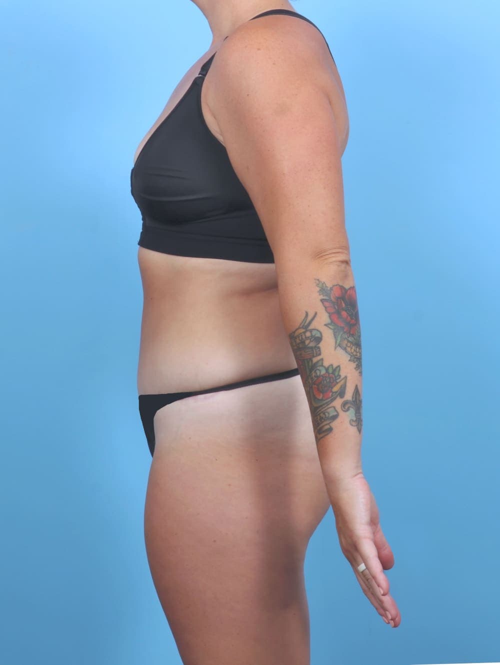 Tummy Tuck case #5813 after, image 3