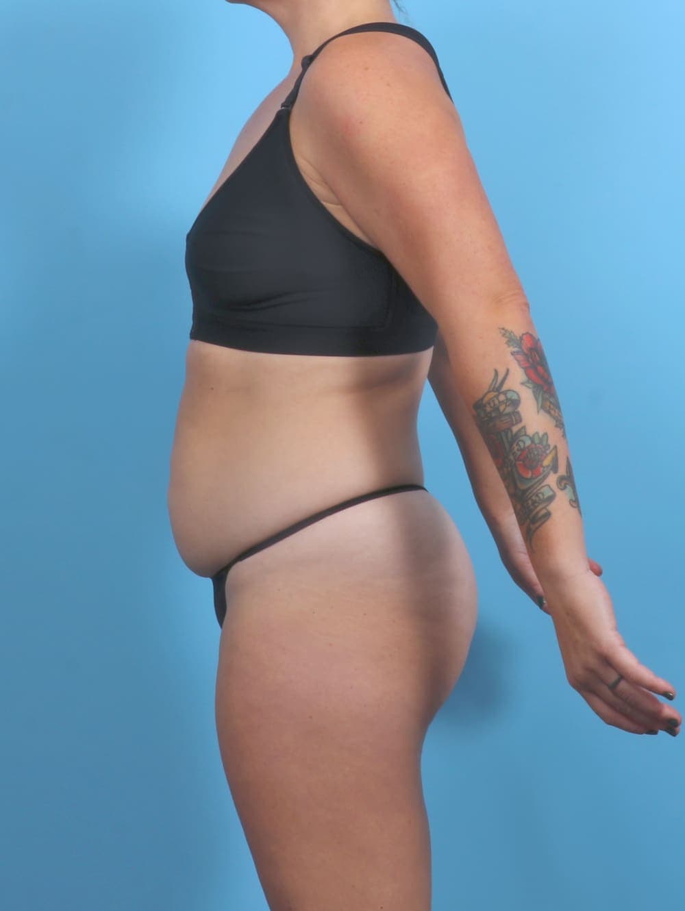 Tummy Tuck case #5813 before, image 3