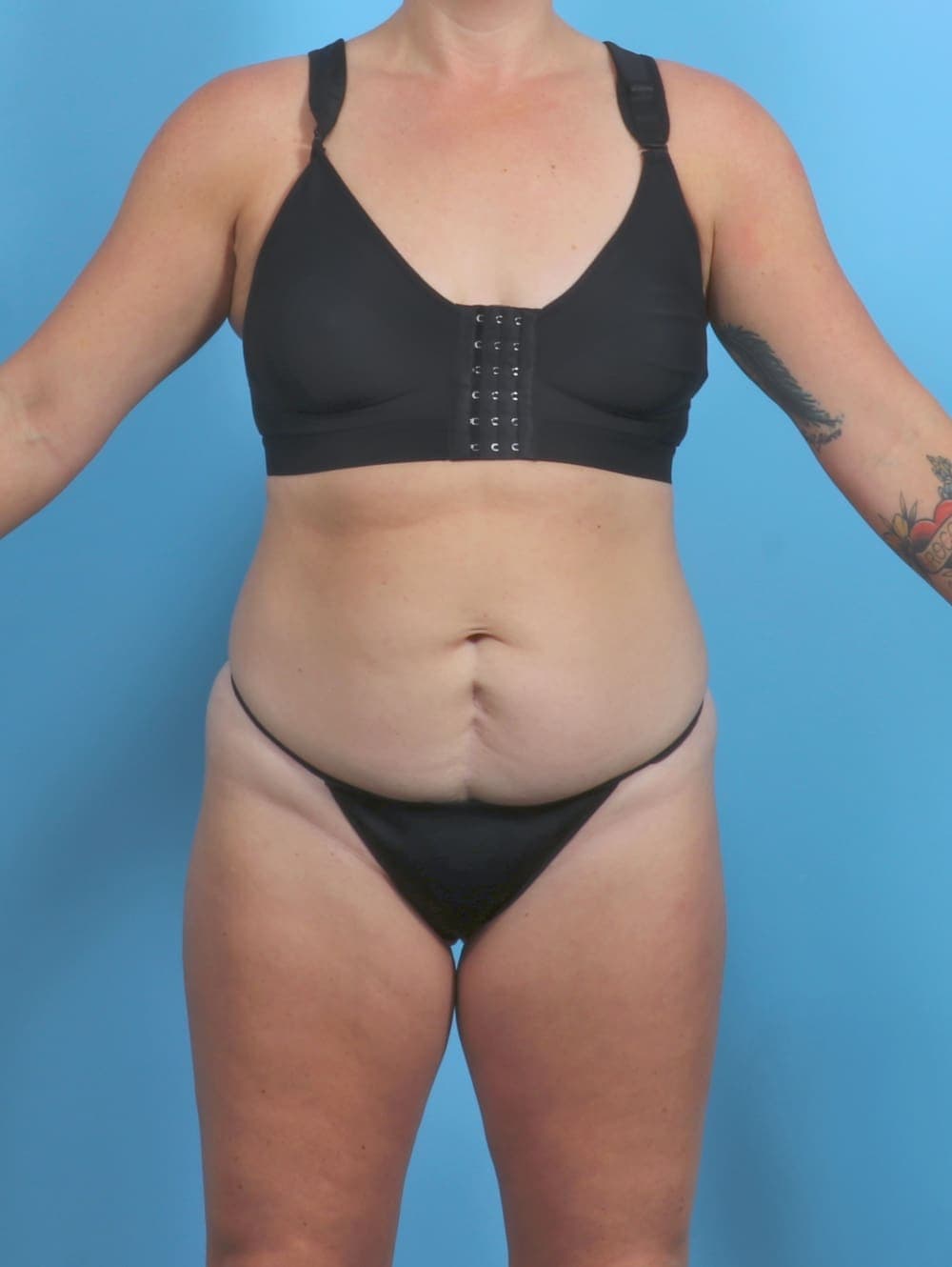 Tummy Tuck case #5813 before, image 1