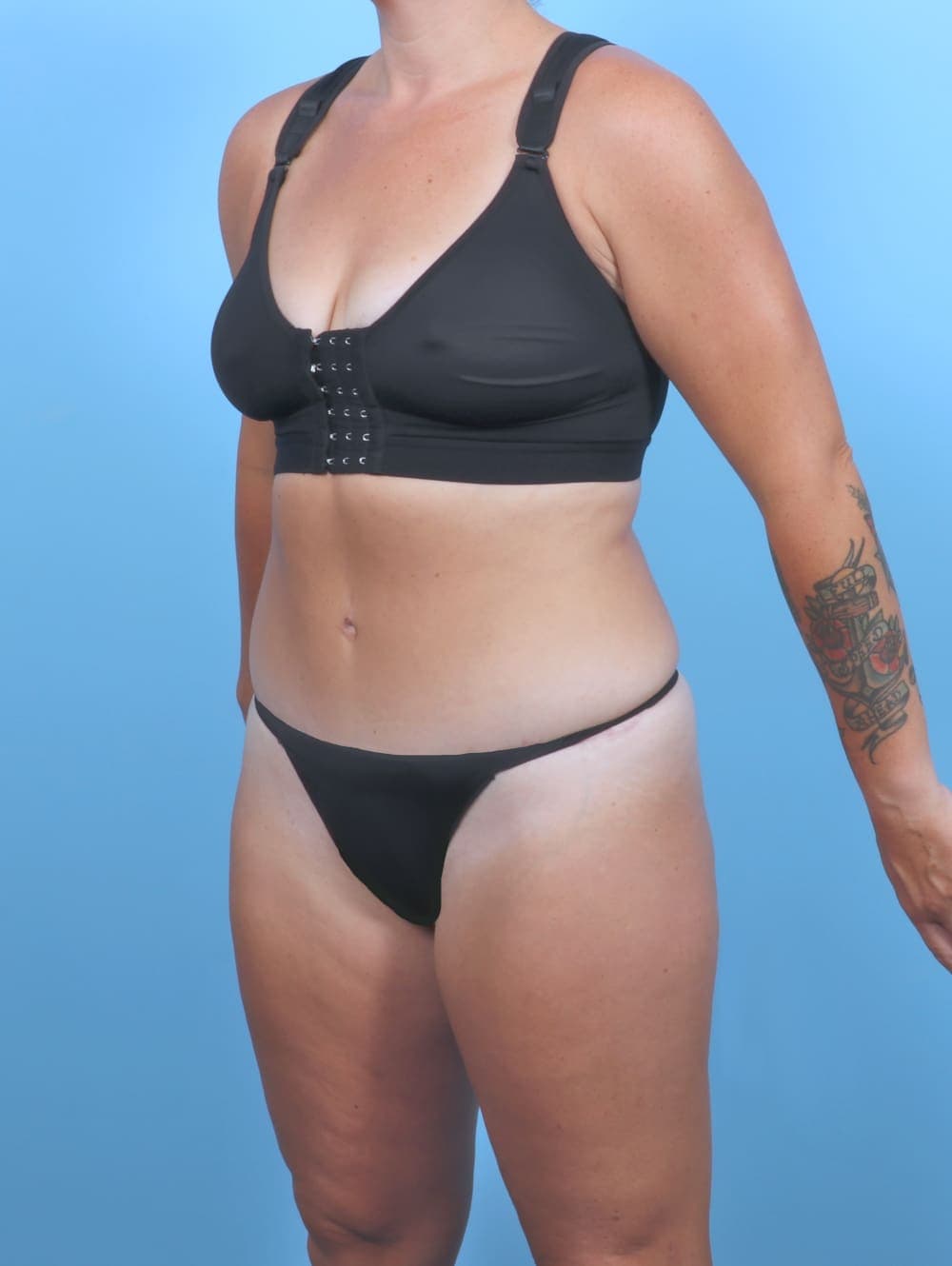 Tummy Tuck case #5813 after, image 2