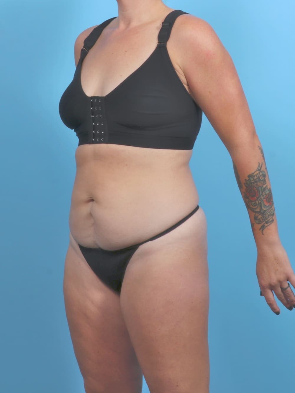 Tummy Tuck case #5813 before, image 2