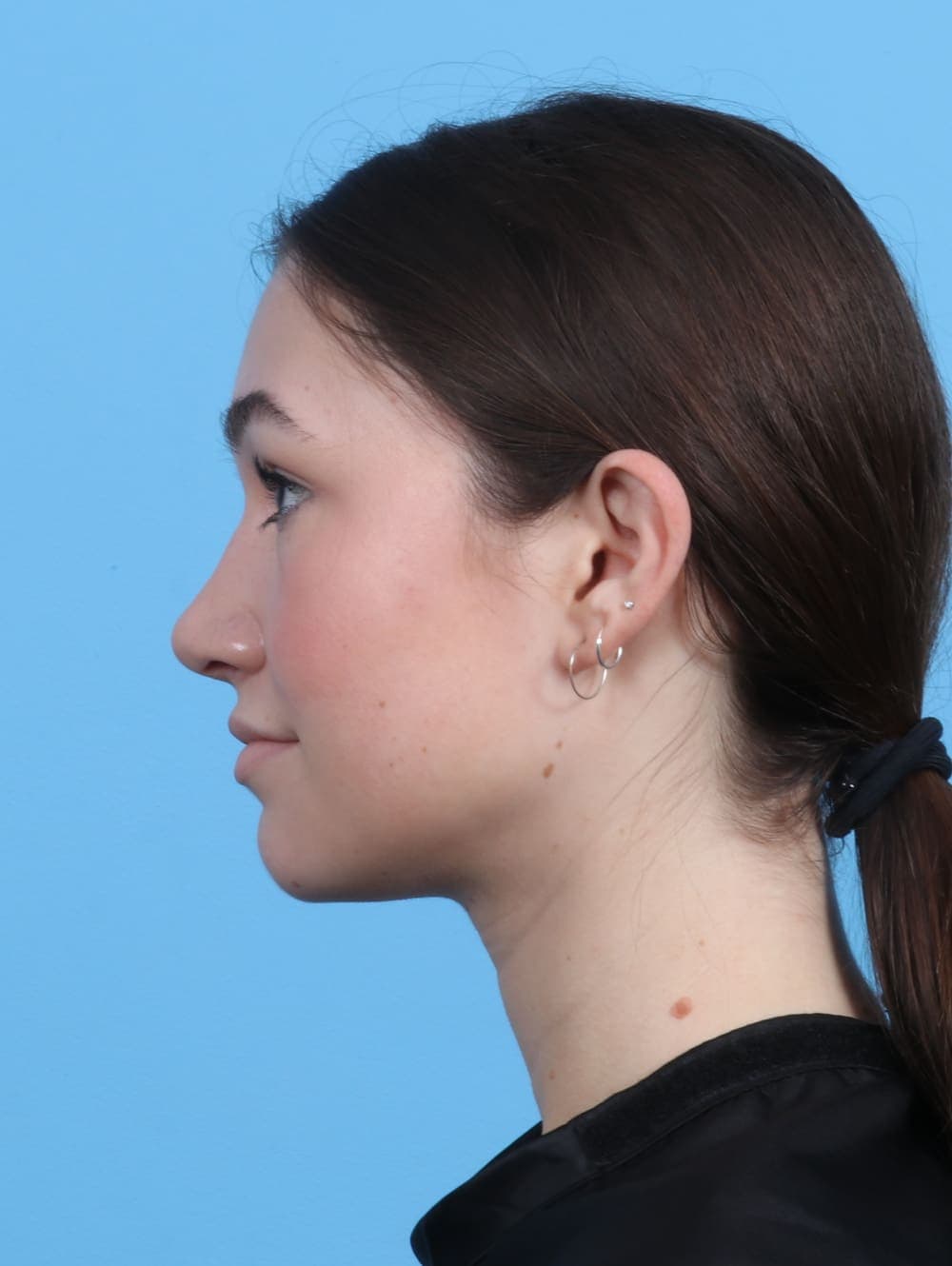 Rhinoplasty case #3311 after, image 1