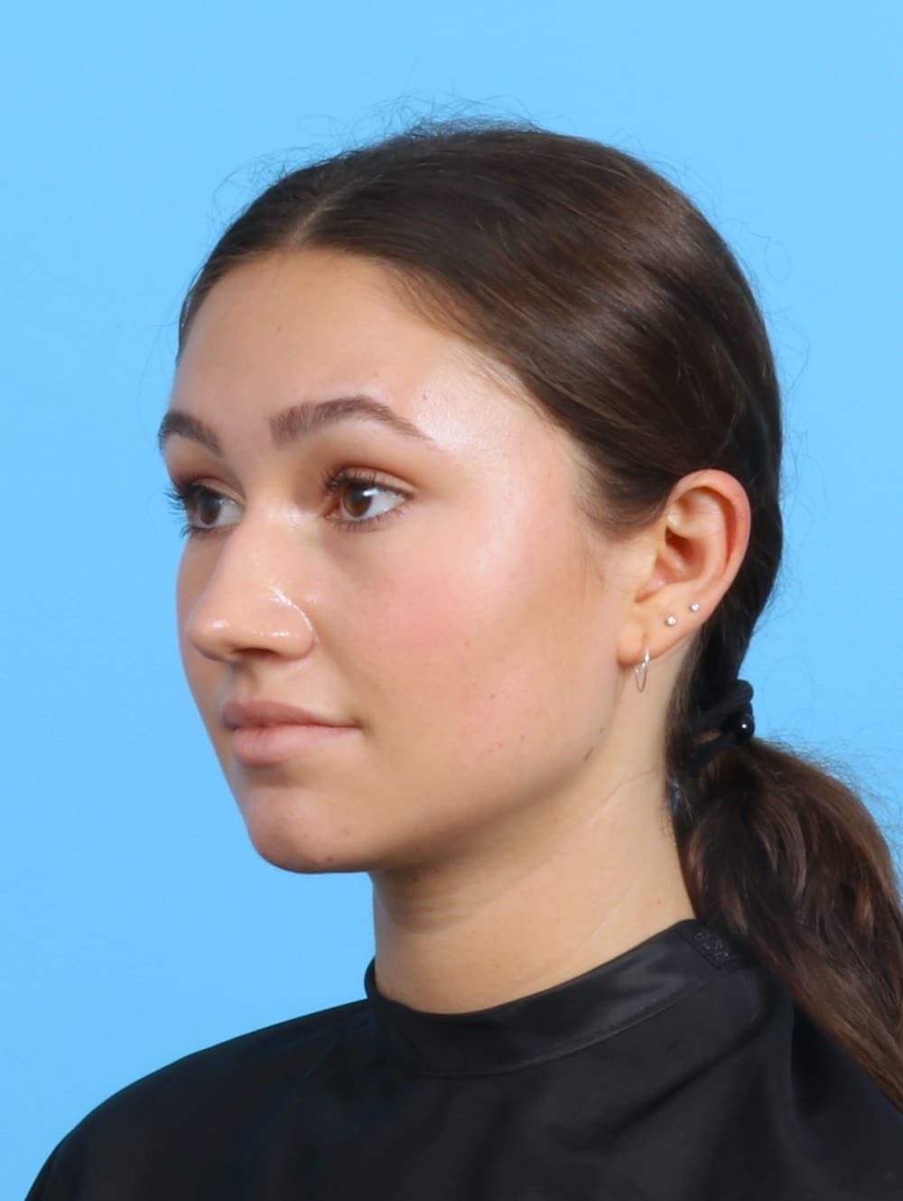 Rhinoplasty case #3311 before, image 3