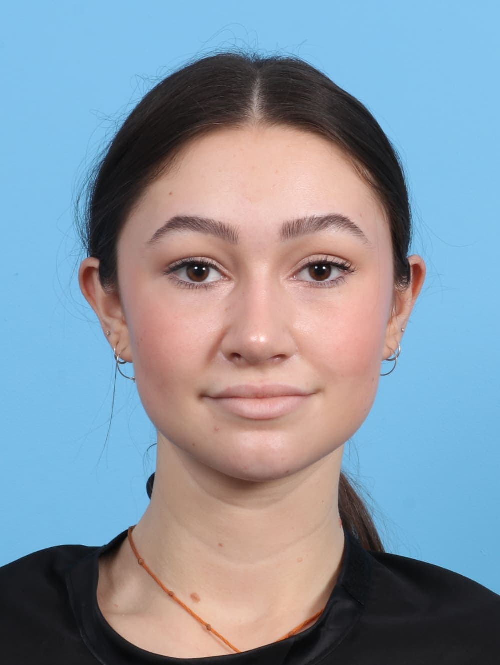 Rhinoplasty case #3311 after, image 2