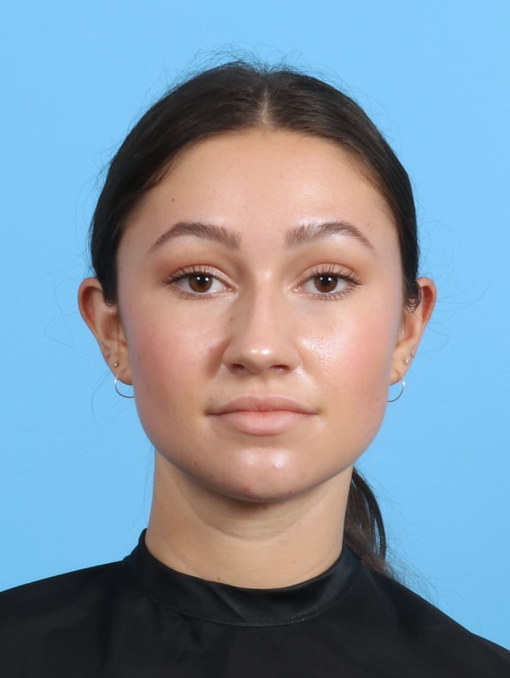 Rhinoplasty case #3311 before, image 2