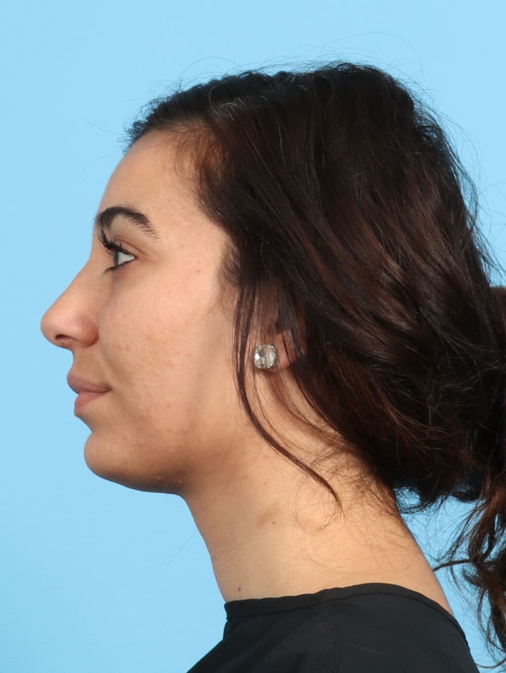 Rhinoplasty case #2354 after