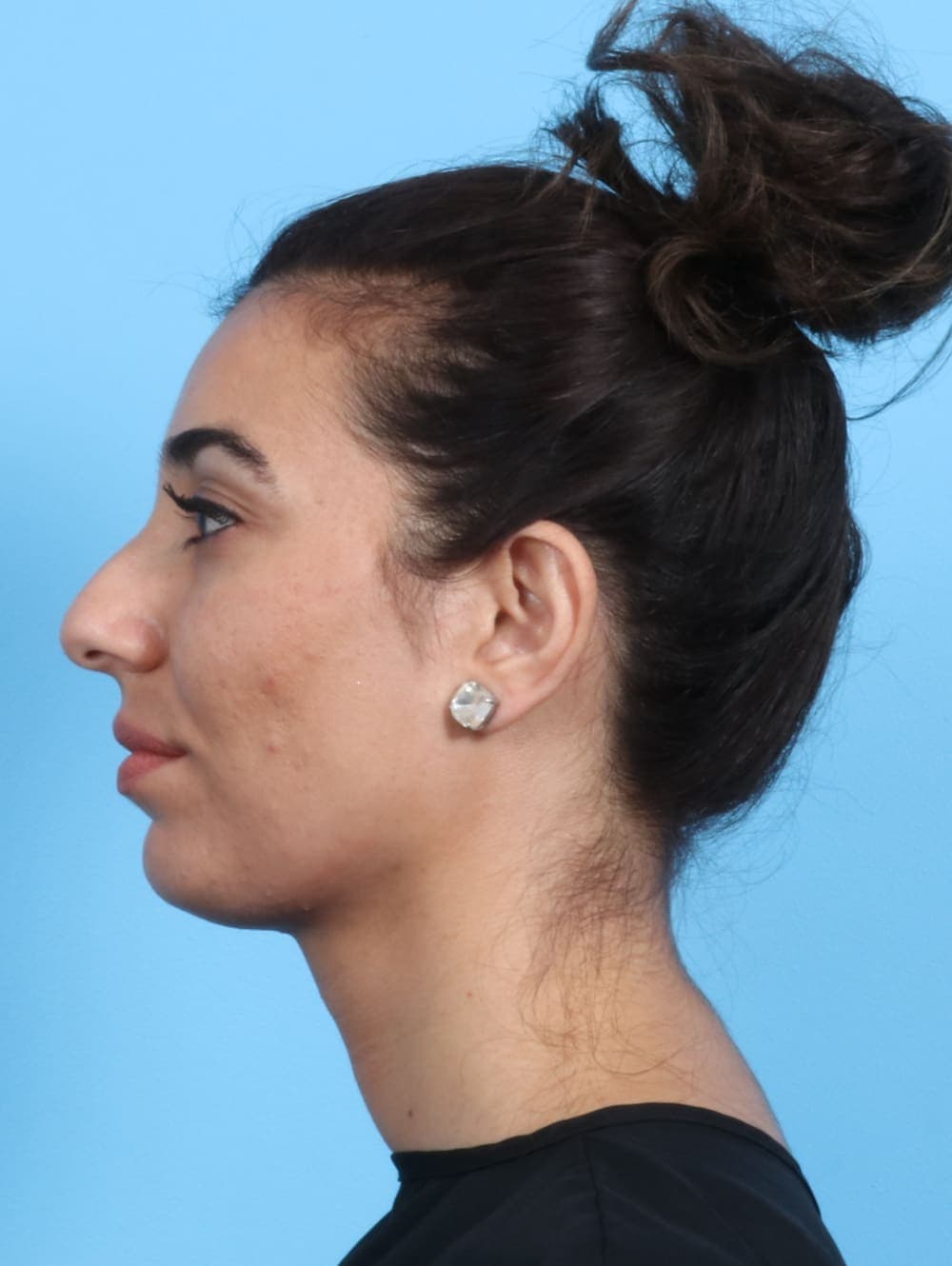 Rhinoplasty case #2354 before