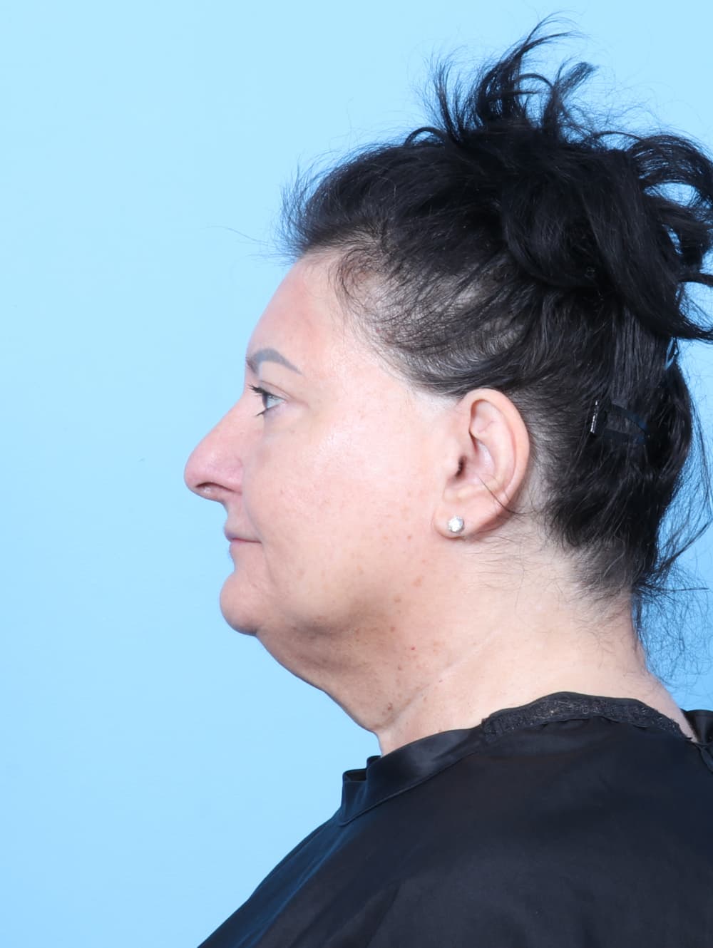 Eyelid Surgery case #7453 after, image 3