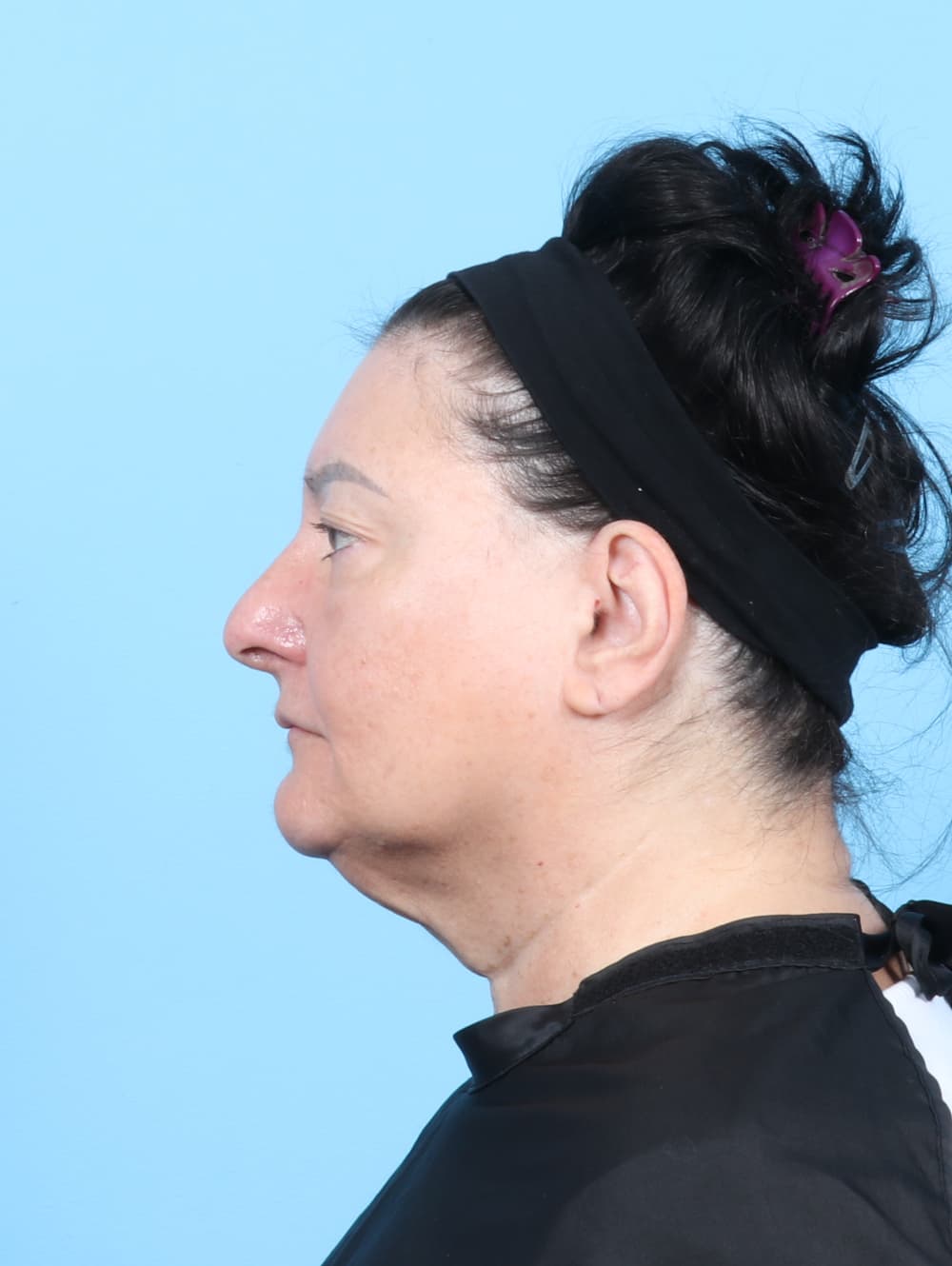 Eyelid Surgery case #7453 before, image 3
