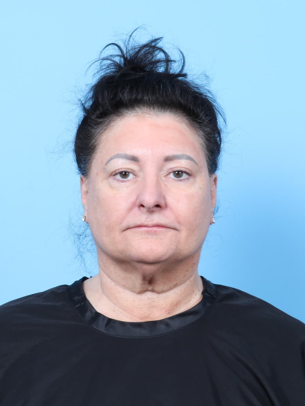 Facial Surgery case #7453 after