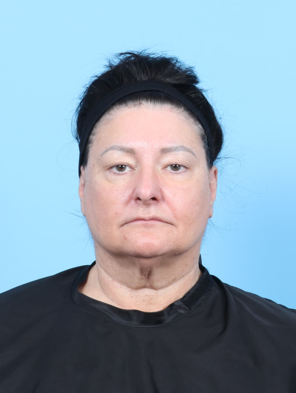 Facial Surgery case #7453 before