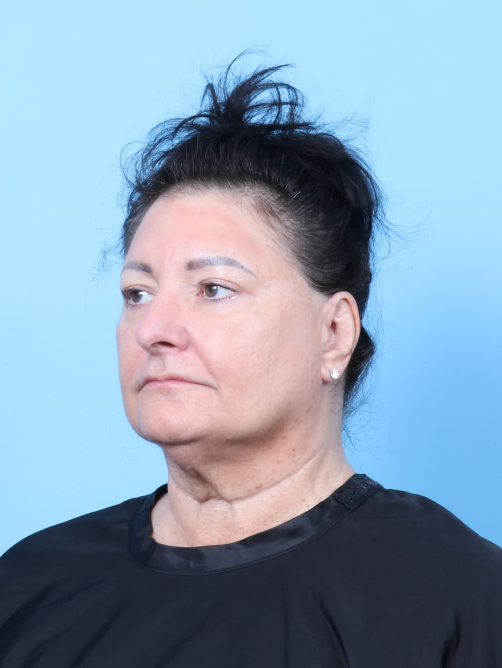 Eyelid Surgery case #7453 after, image 2