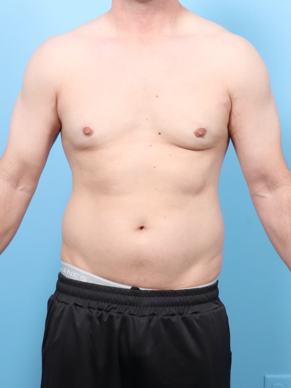 Body Contouring case #7527 after
