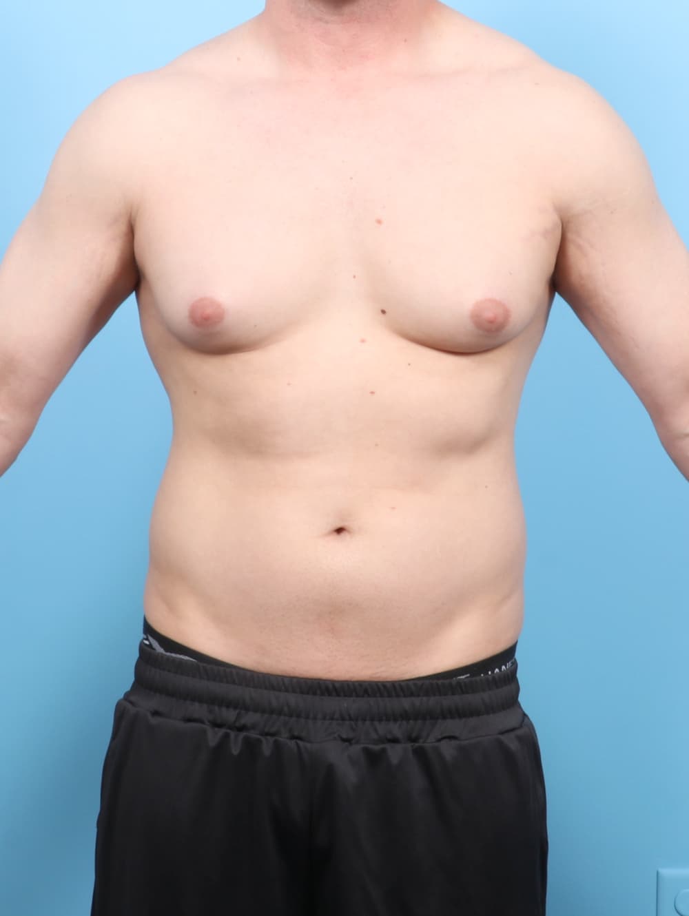 Body Contouring case #7527 before