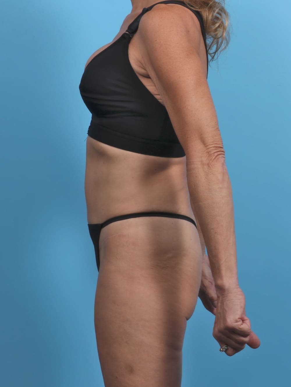 Tummy Tuck case #3933 after, image 3