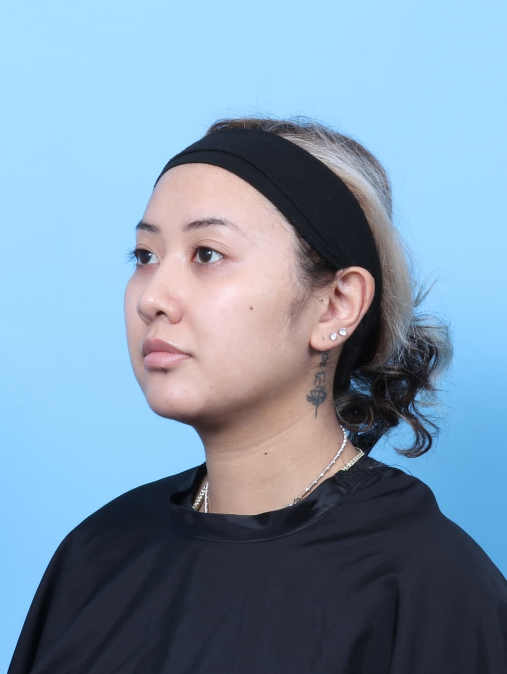 Rhinoplasty case #7606 after, image 3