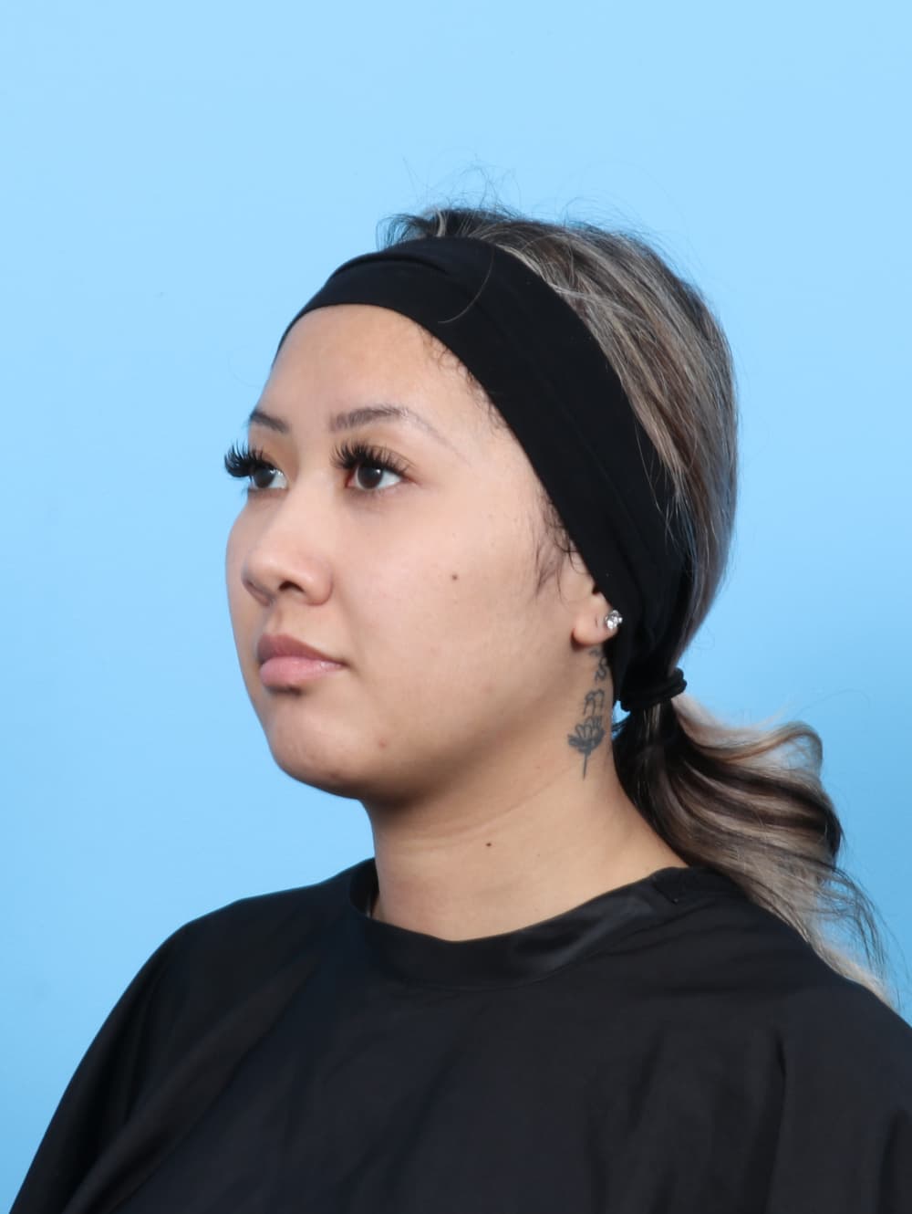 Rhinoplasty case #7606 before, image 3