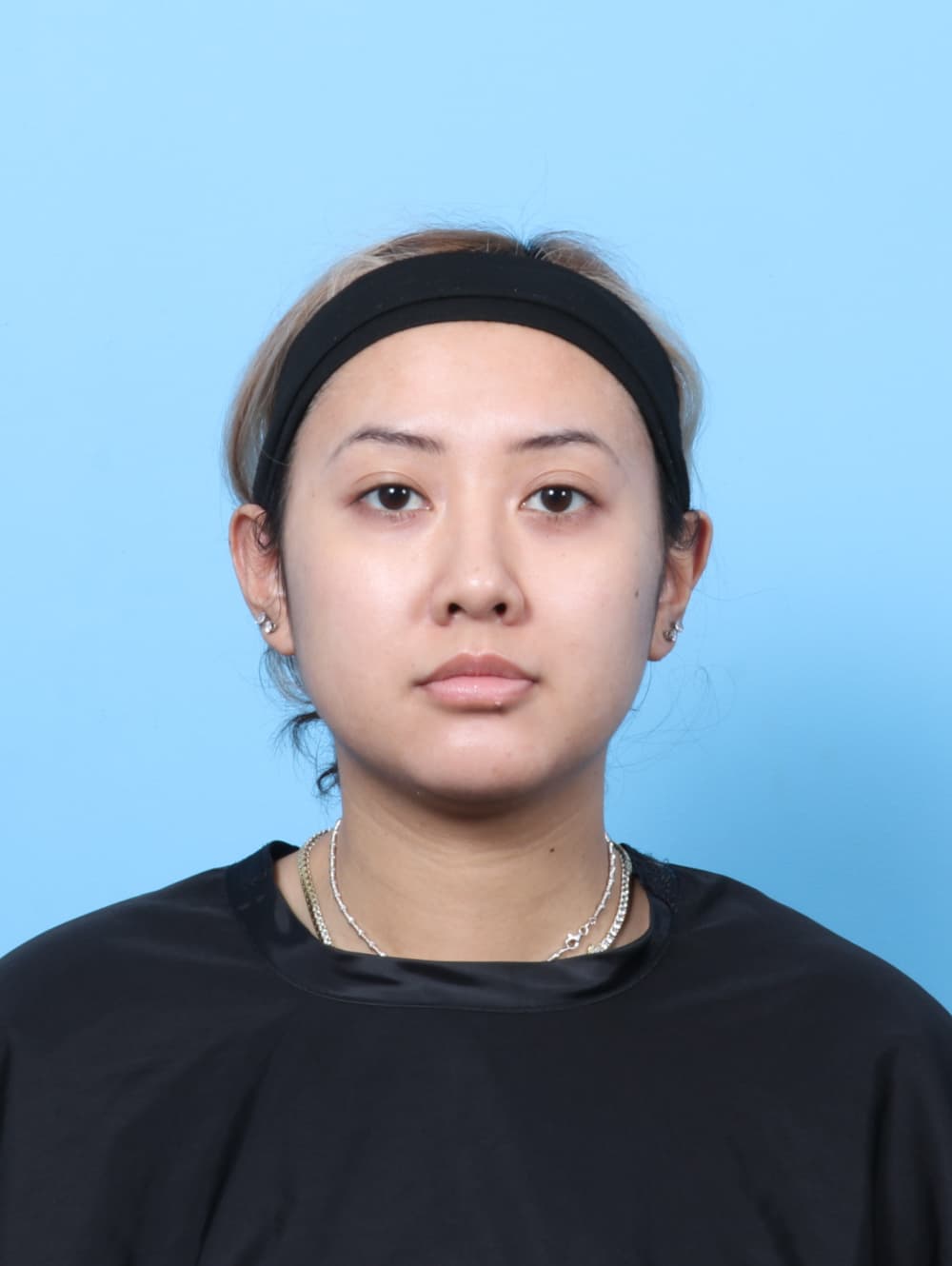Rhinoplasty case #7606 after, image 2