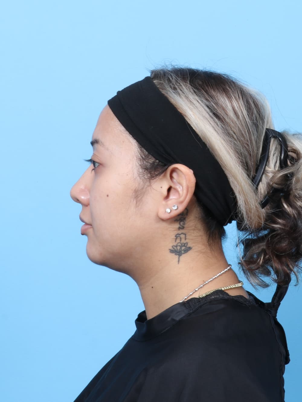 Facial Surgery case #7606 after