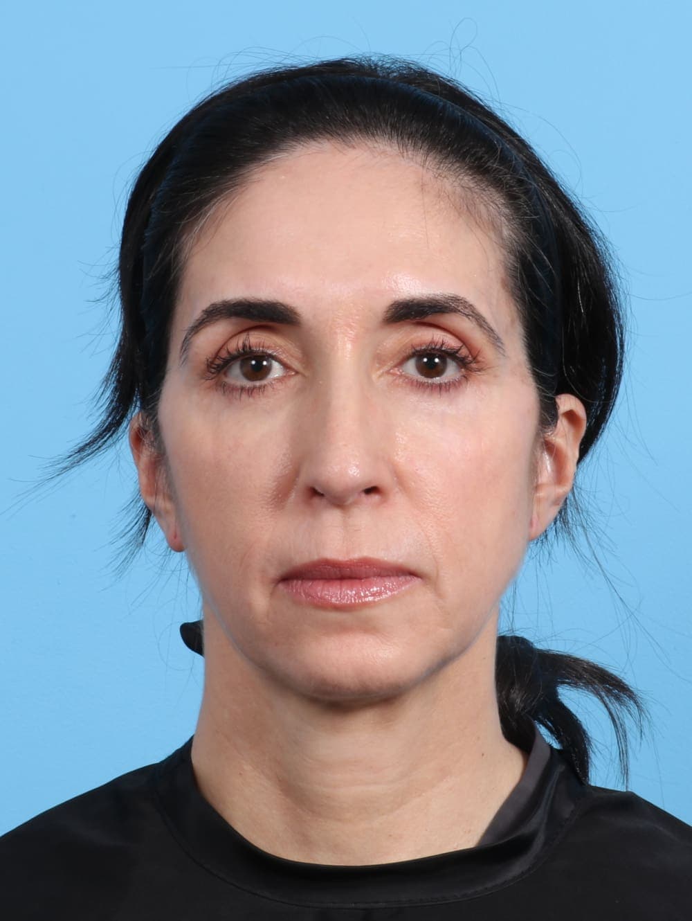 Eyelid Surgery case #2963 after