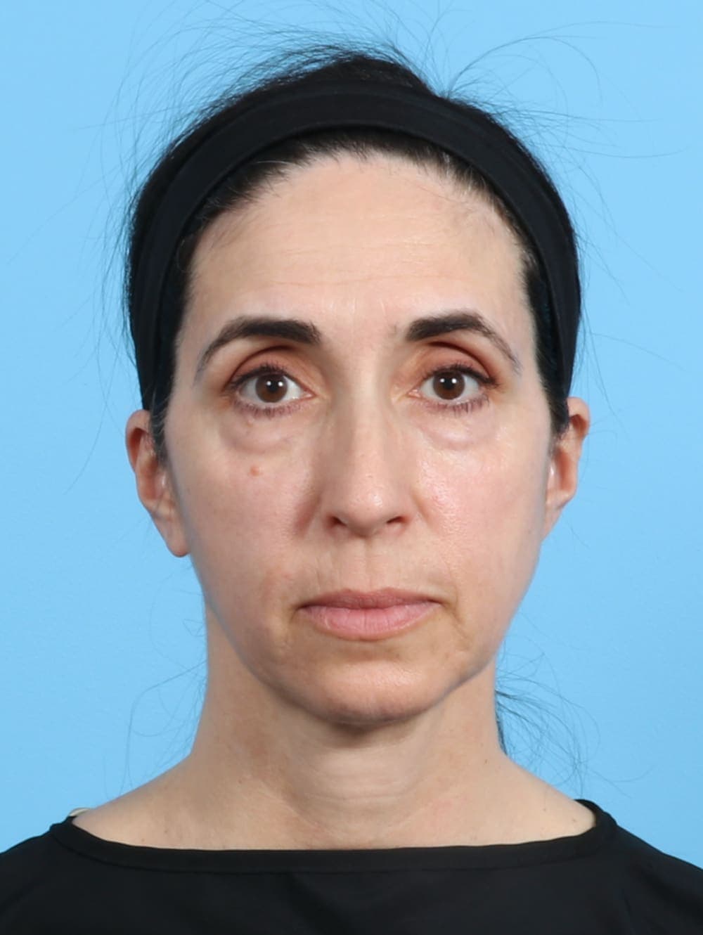 Eyelid Surgery case #2963 before