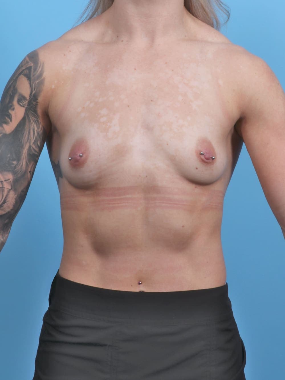 Breast Augmentation case #5309 before