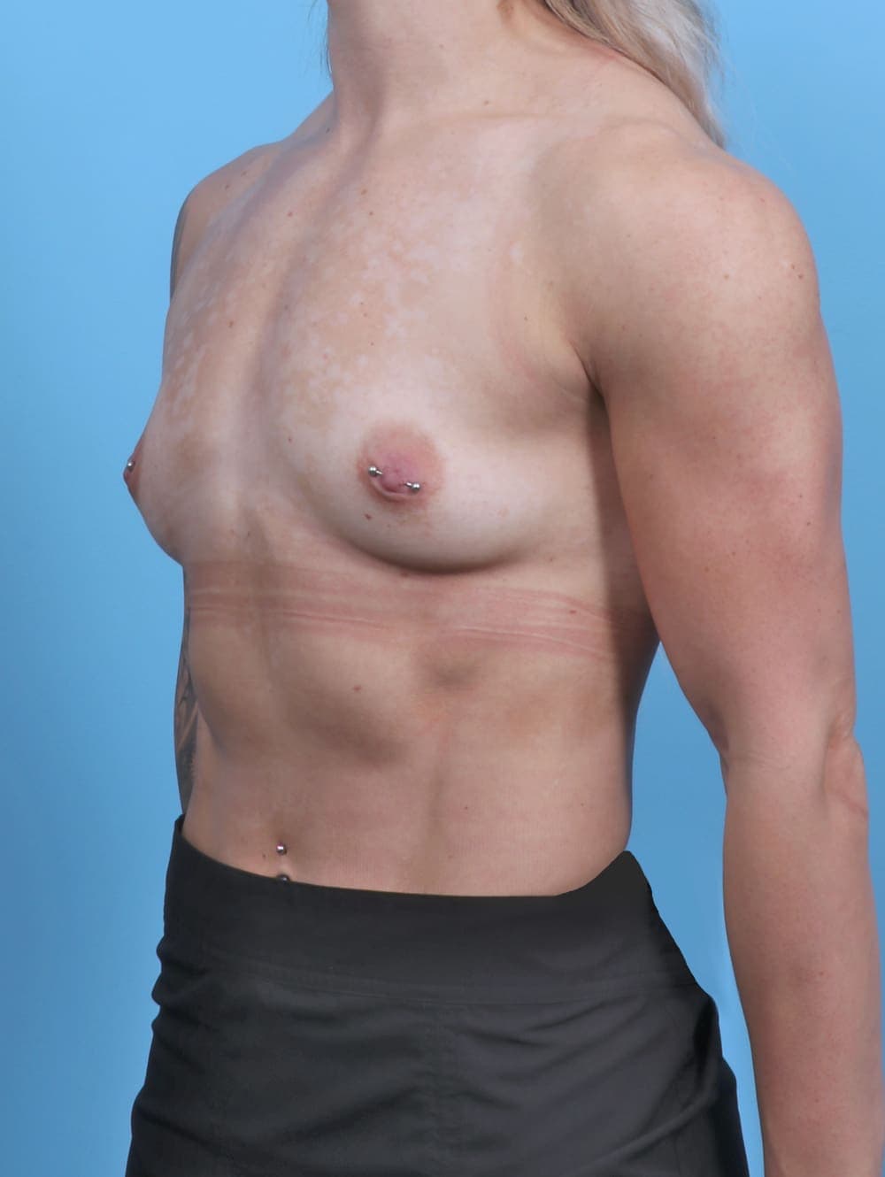 Breast Augmentation case #5309 before, image 2
