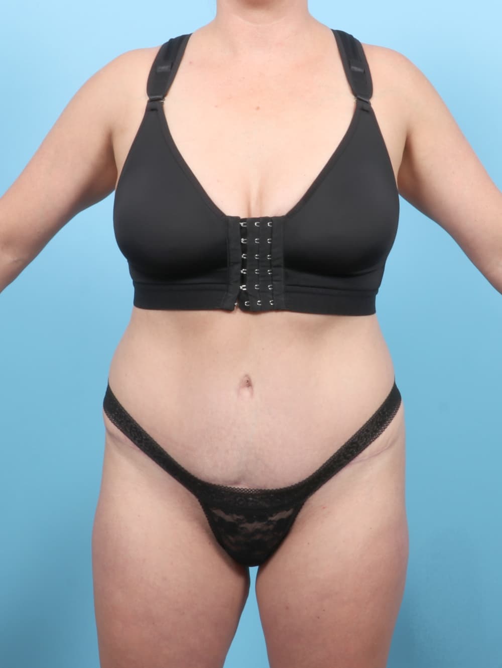 Tummy Tuck case #7016 after