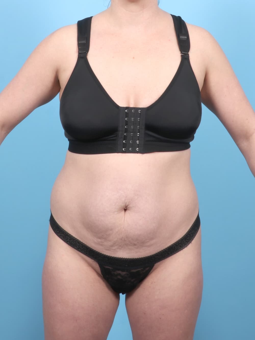 Tummy Tuck case #7016 before