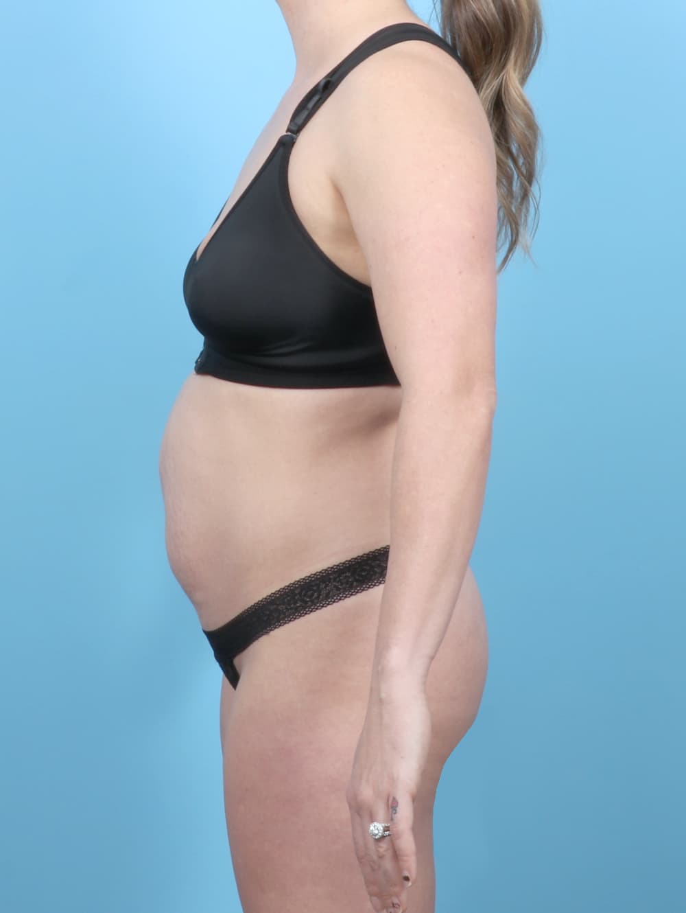 Tummy Tuck case #7016 before, image 3