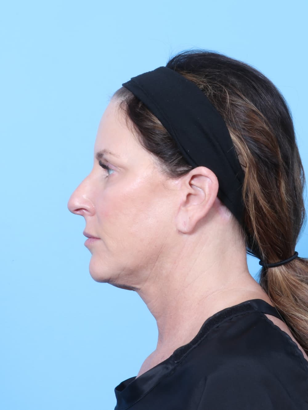Facelift case #7622 after, image 4