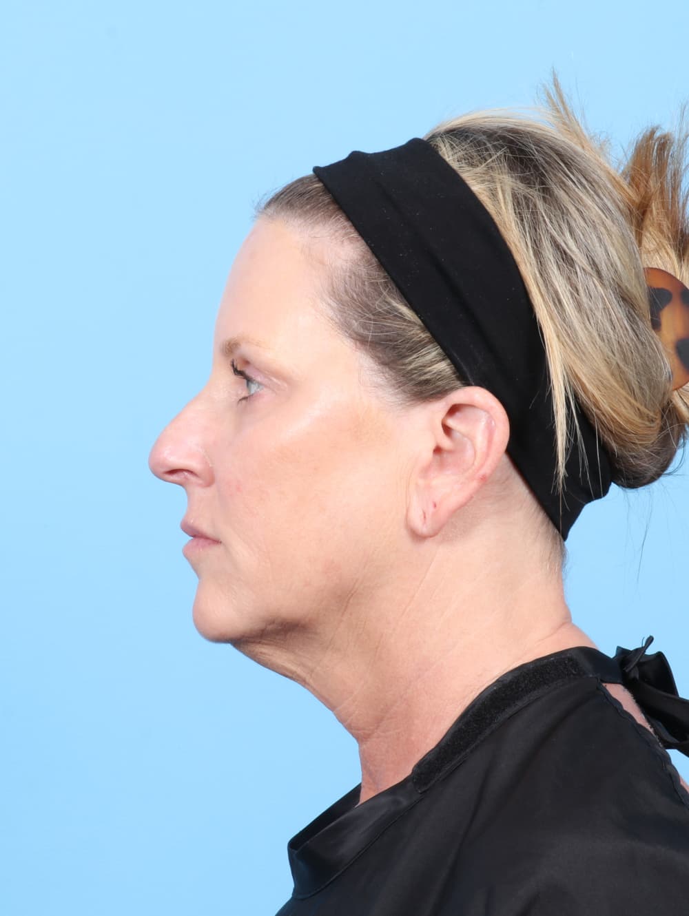 Facelift case #7622 before, image 4