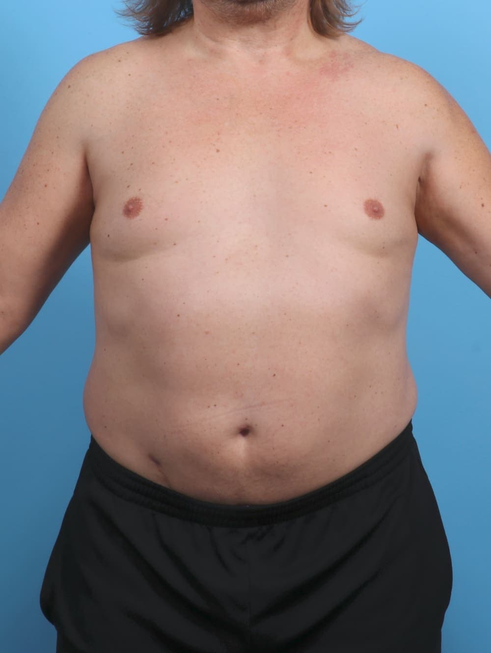 Liposuction case #4569 after