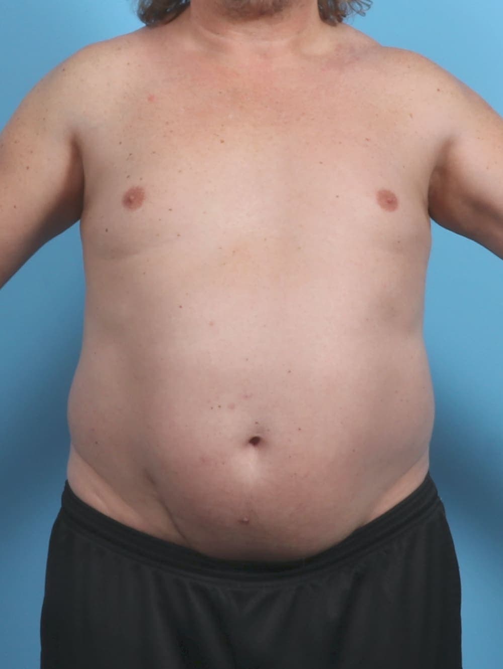 Liposuction case #4569 before