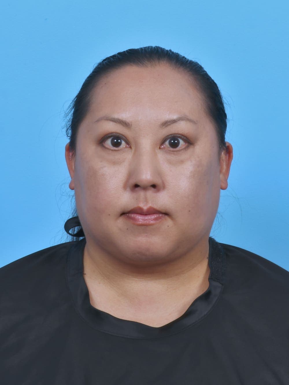 Liposuction case #5644 after