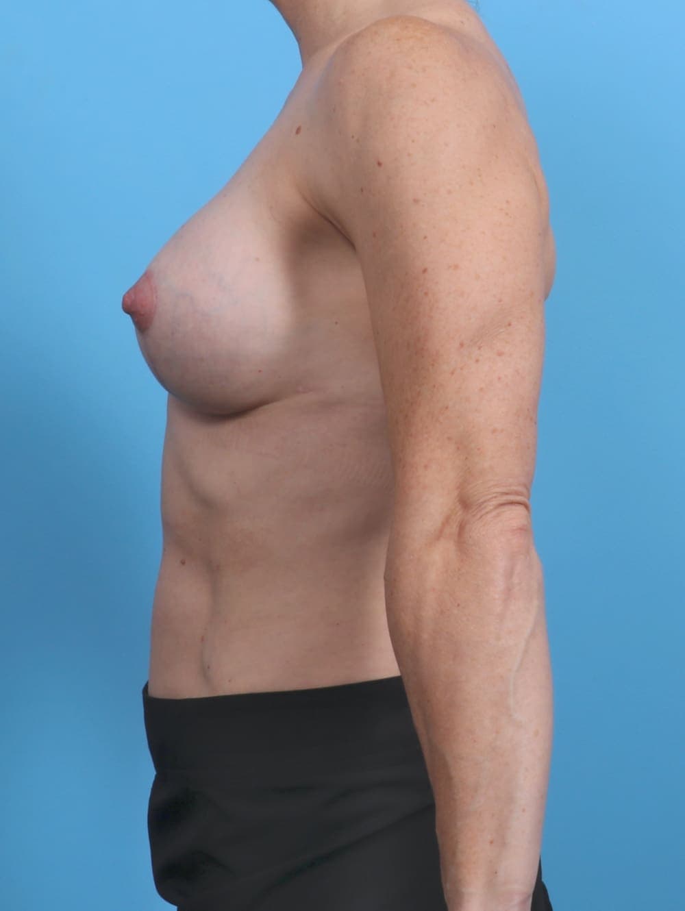 Breast Lift with Implants case #4355 after, image 3