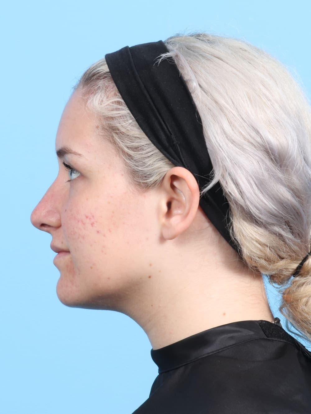 Rhinoplasty case #2585 after