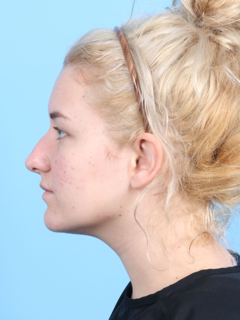 Rhinoplasty case #2585 before