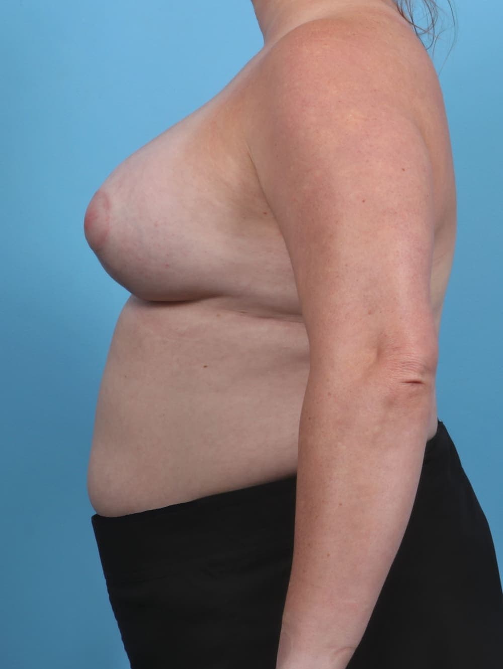 Breast Implant Revision case #3890 after, image 3