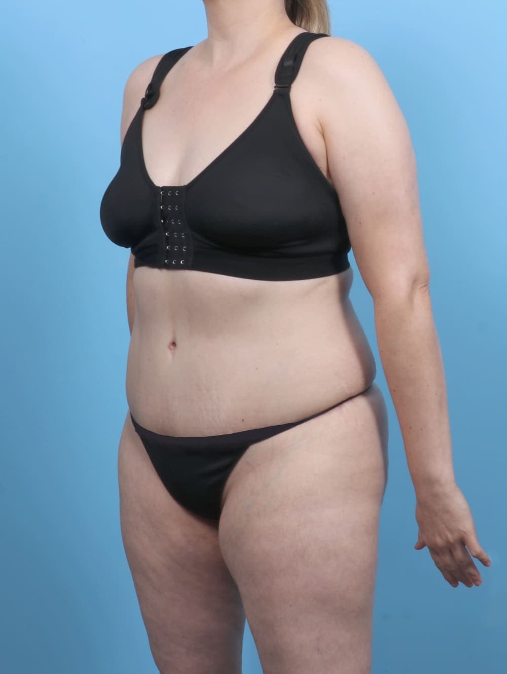 Tummy Tuck case #5552 after, image 2