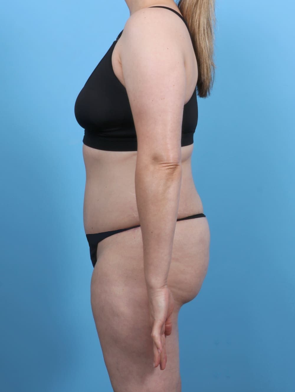Tummy Tuck case #5552 after, image 3
