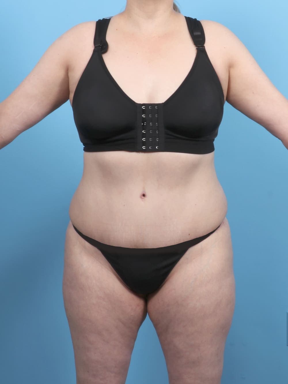 Tummy Tuck case #5552 after, image 1