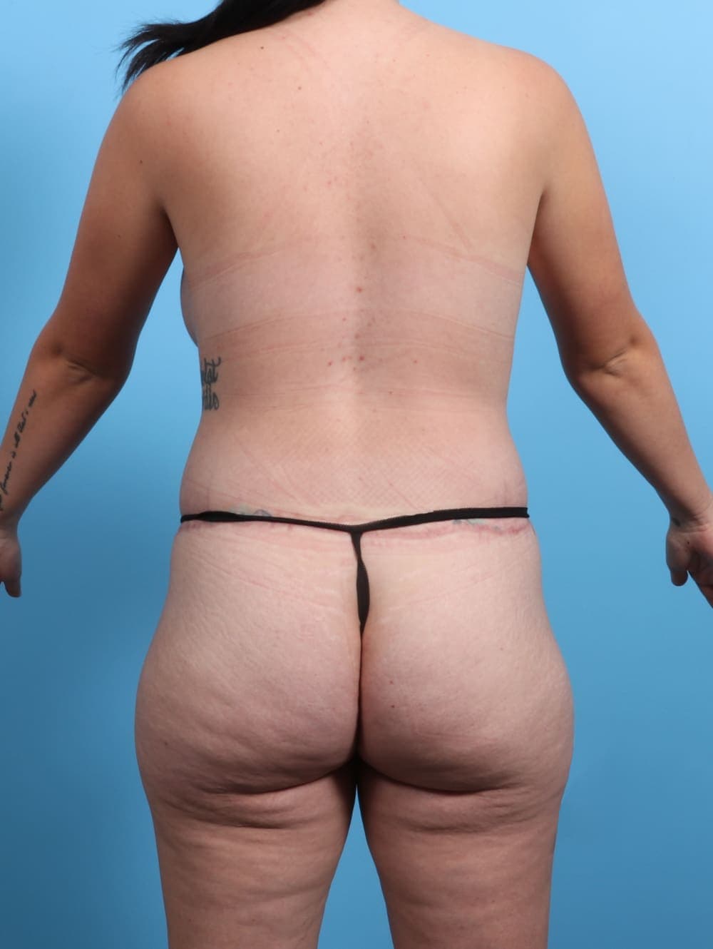 Breast Augmentation case #3042 after, image 2