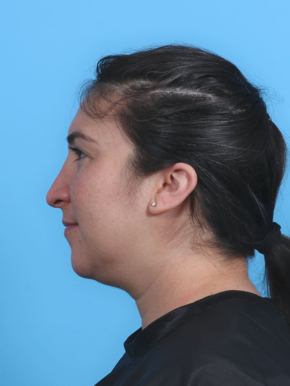 Facial Surgery case #4155 after