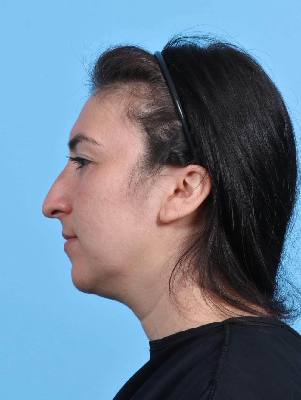 Facial Surgery case #4155 before