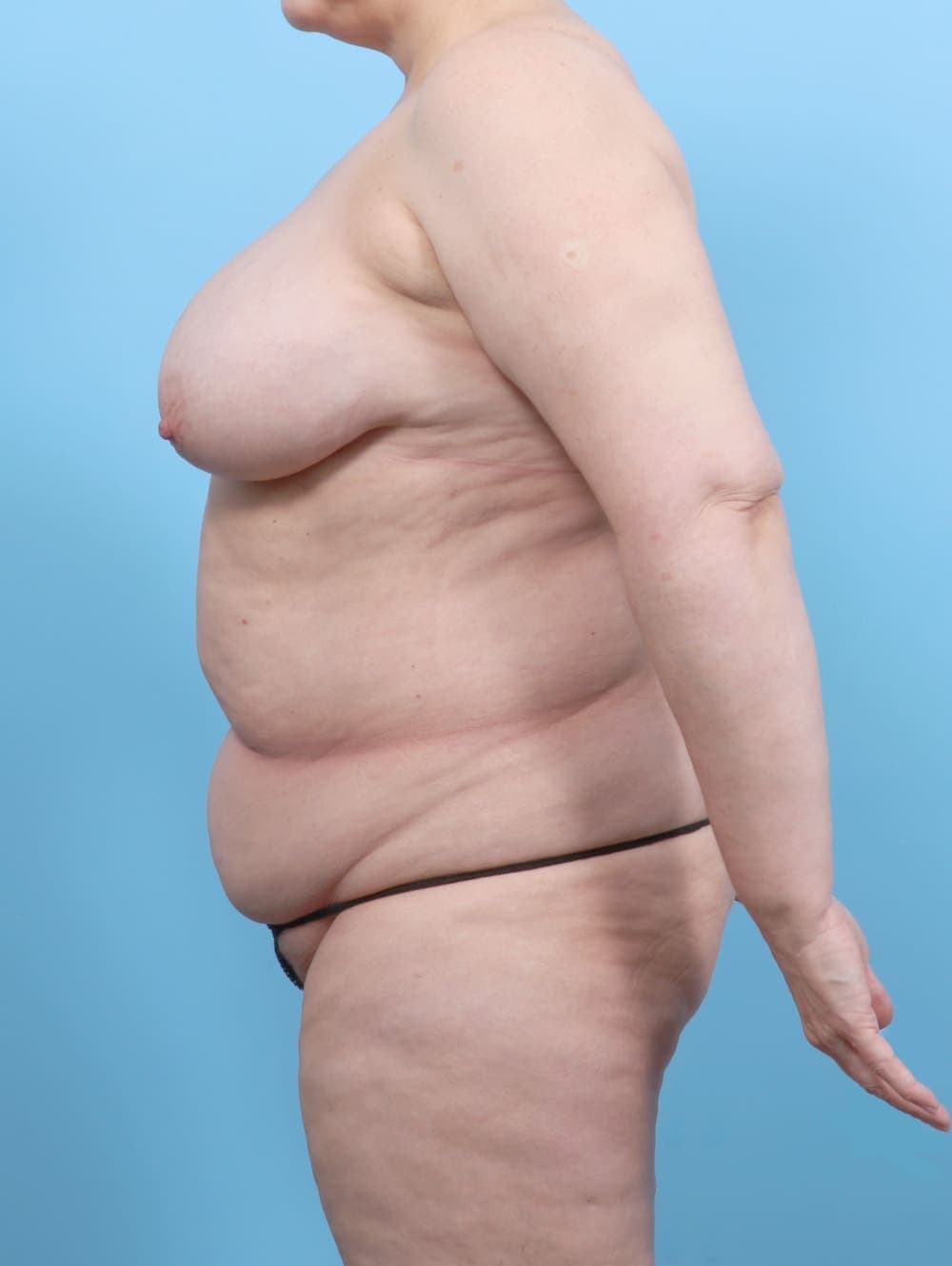 Breast Lift/Reduction case #6497 before, image 4