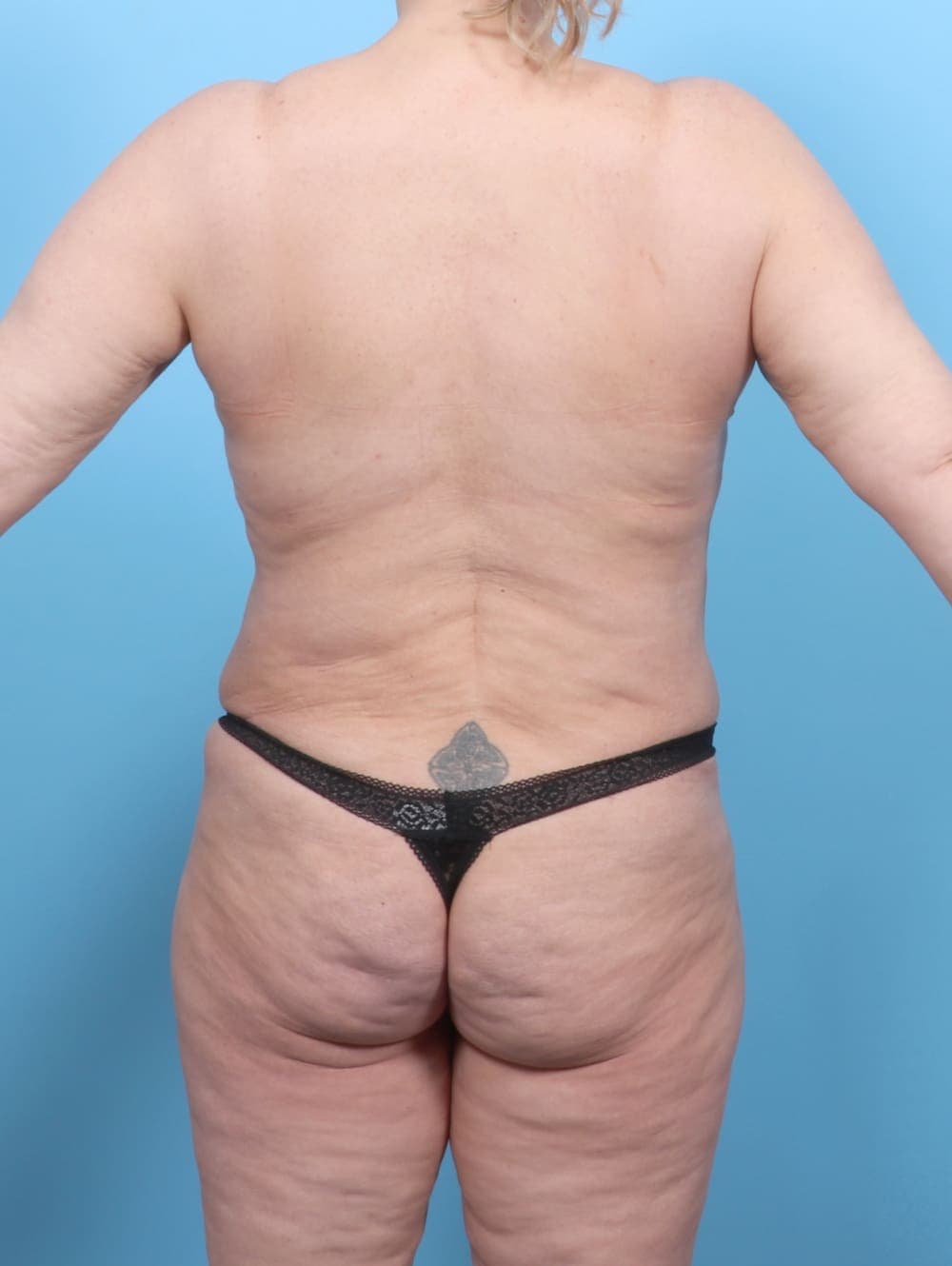 Breast Lift/Reduction case #6497 after, image 2