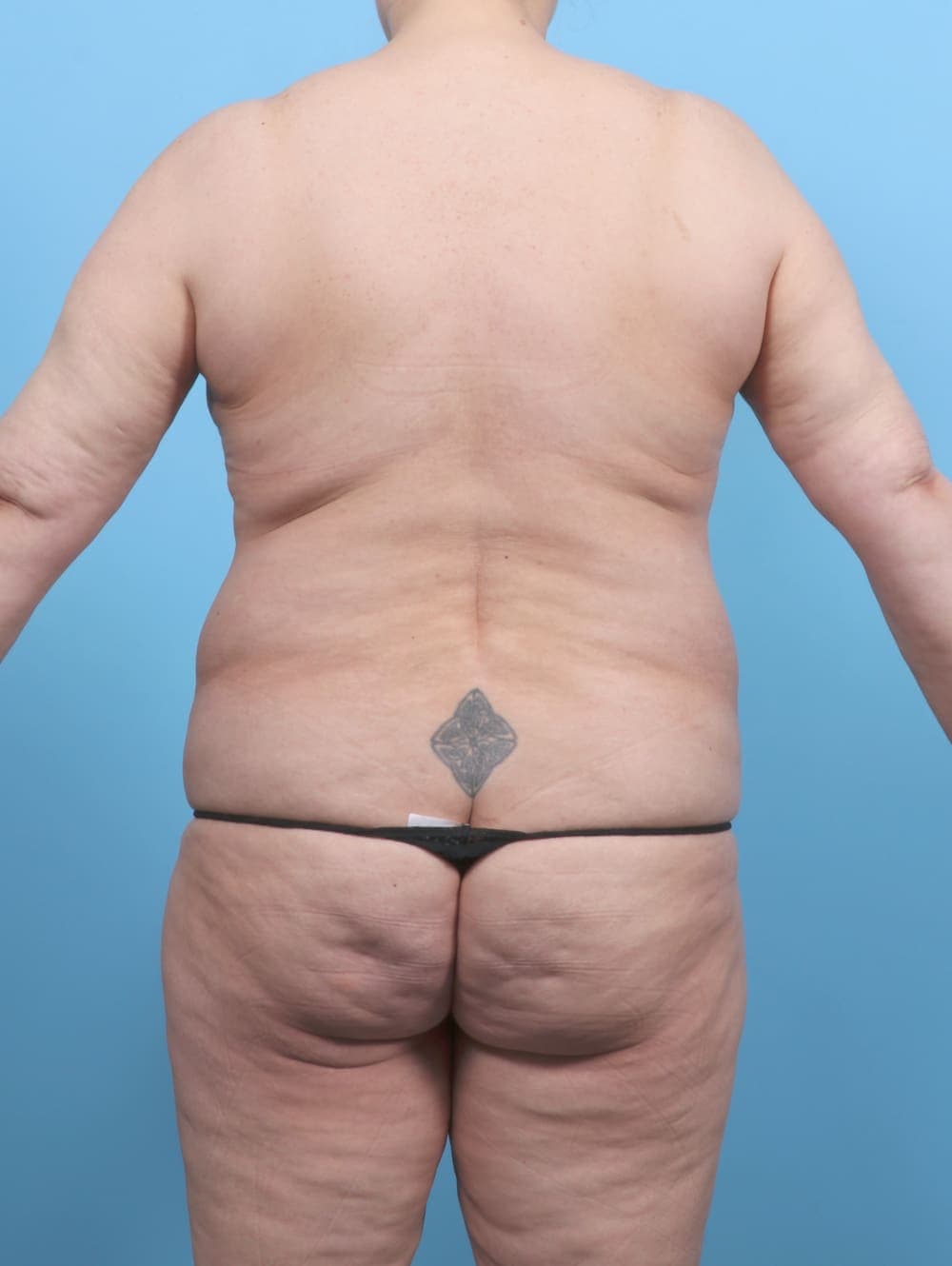 Breast Lift/Reduction case #6497 before, image 2