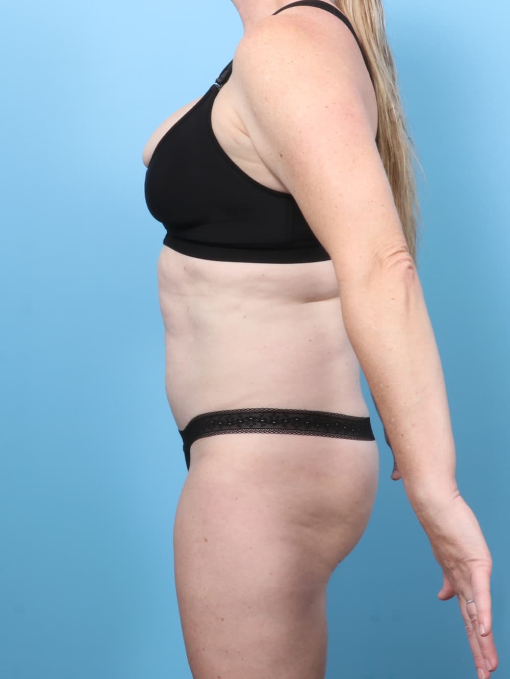 Tummy Tuck case #8674 after, image 3