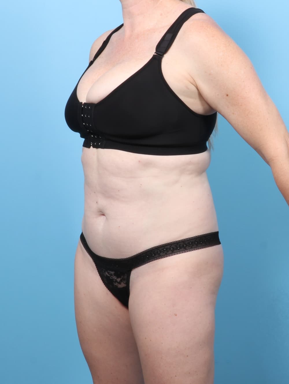 Tummy Tuck case #8674 after, image 2